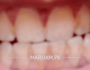 Teath Problem|pilapun