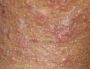 Severe Heat Rashes