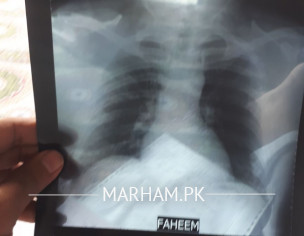 Breathing Shortage Difficult