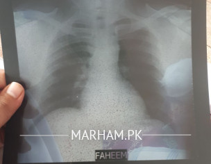 Breathing Shortage Difficult