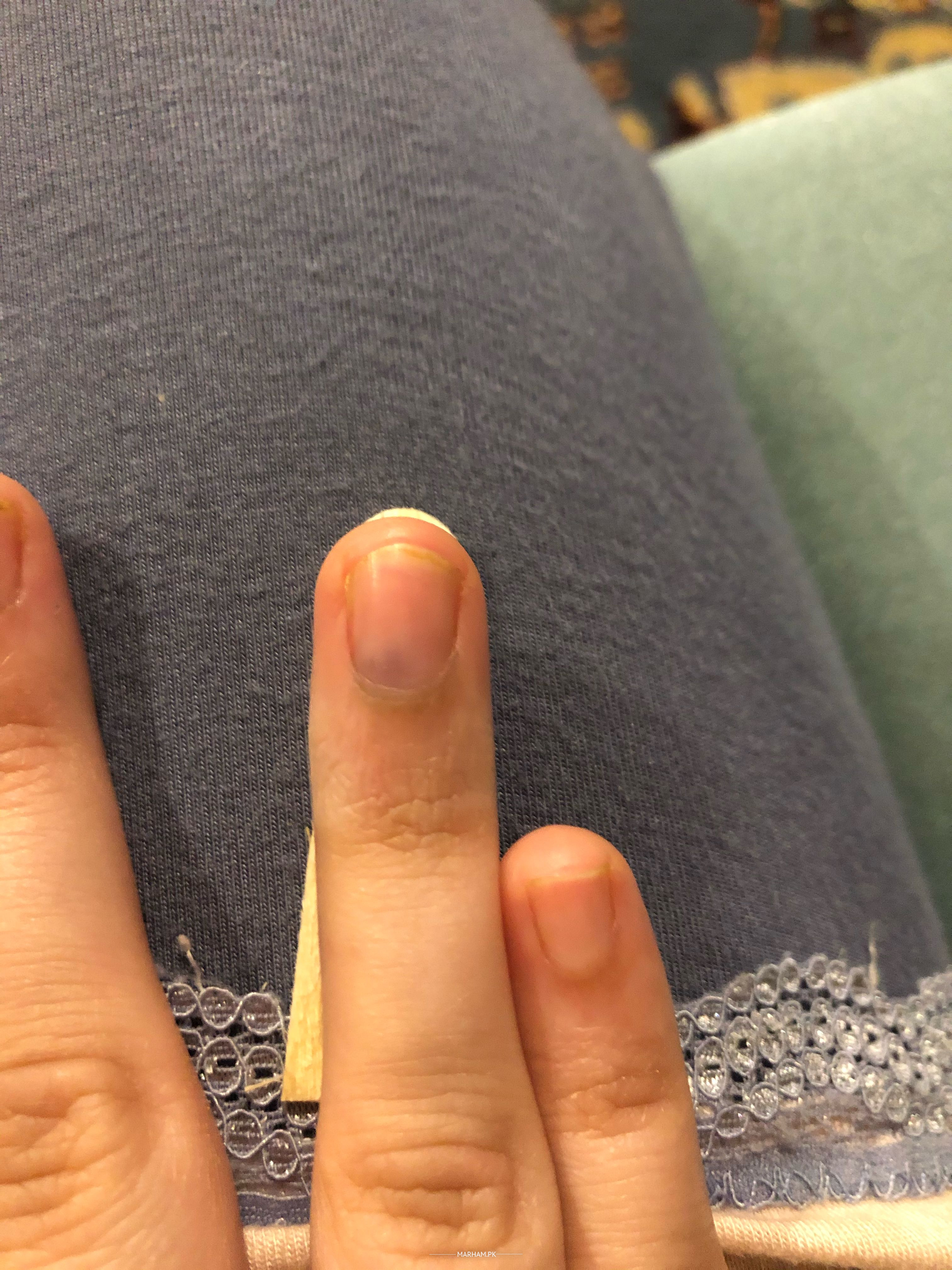 Ask a Dermatologist Online for Pain In Fingernail Bed