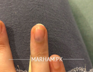 Pain In Fingernail Bed