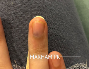 Pain In Fingernail Bed