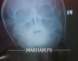 Breathing Difficulty