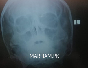 Breathing Difficulty