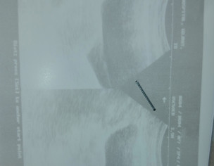 Ist Trimester Bleeding 