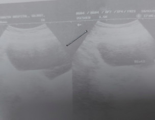 Ist Trimester Bleeding 