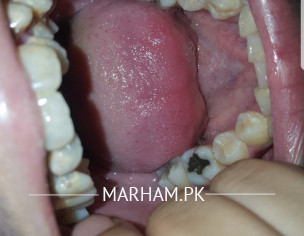 Teeth Decay And Other Problems