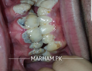 Teeth Decay And Other Problems