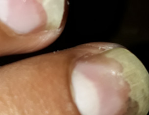 Nail Problem 
