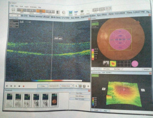 Black Spots In Vision/ Blurred Image
