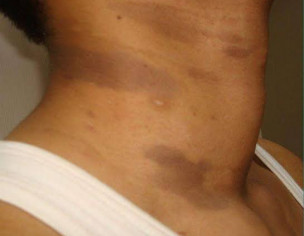 Lichen Planus Pigmentosus