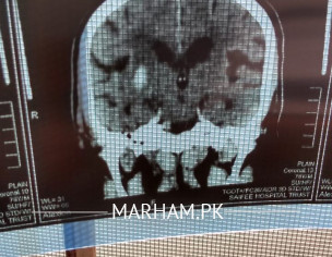CT SCAN Report, Please Someone Help Me Understand This Condition 