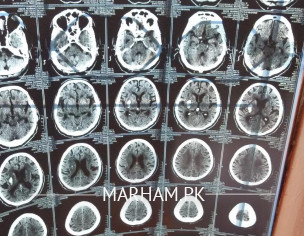 CT SCAN Report, Please Someone Help Me Understand This Condition 