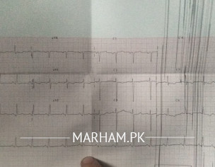 CT SCAN Report, Please Someone Help Me Understand This Condition 