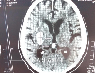 CT SCAN Report, Please Someone Help Me Understand This Condition 