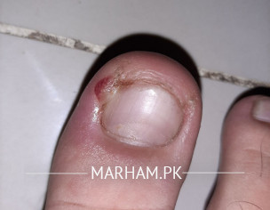 Ingrowing Toenail