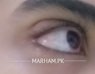 Bump On Eyelid. Help