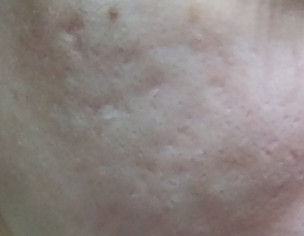 Acne Scars