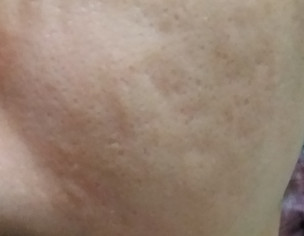 Acne Scars