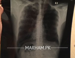 Sputum In Lungs, Cough, Weakness