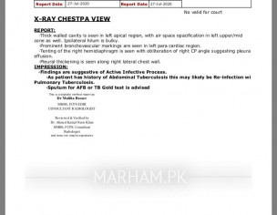 Sputum In Lungs, Cough, Weakness