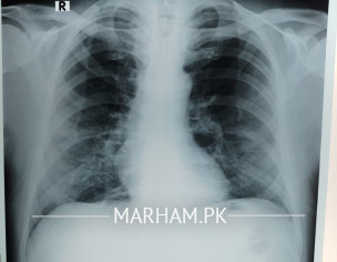 Chest X Ray 