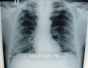 Chest X Ray 