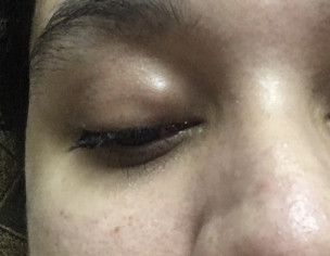 Eyelid Lump