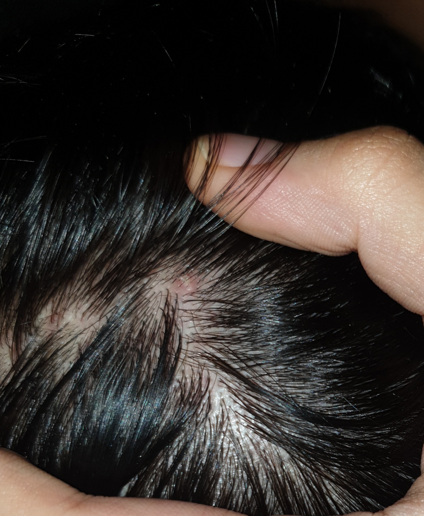 folliculitis scalp