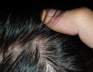 Folliculitis On Scalp And Face
