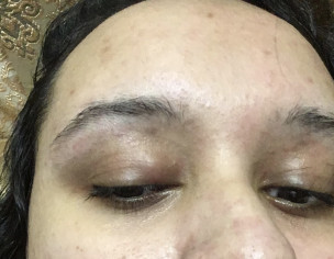 Eye Chalazion &amp; Weakness