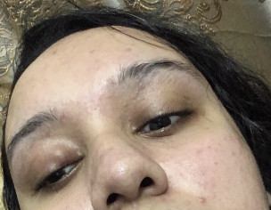 Eye Chalazion &amp; Weakness