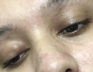 Eye Chalazion &amp; Weakness