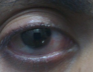 Eyelid Problem