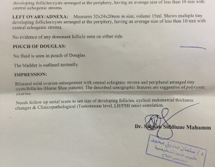 POly Cyst Overian Syndrome 