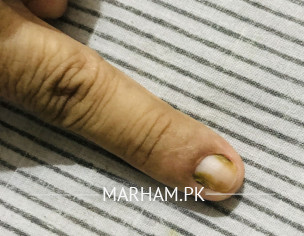 Fungus In Nails 
