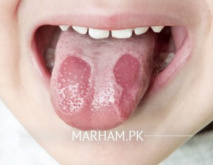 Geographic Tongue