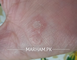 Marks On Hand