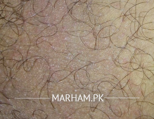 Rashes On Inner Thighs