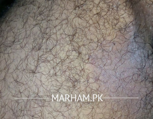 Rashes On Inner Thighs