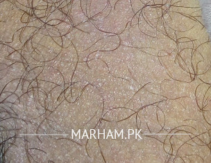 Rashes On Inner Thighs