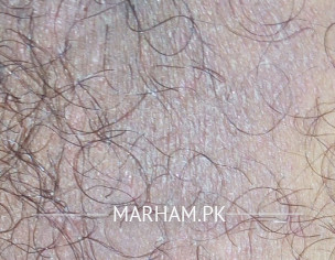 Rashes On Inner Thighs