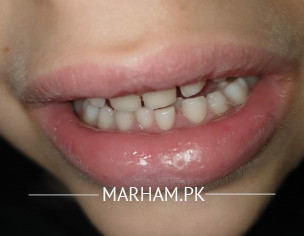Milk Teeth Extraction