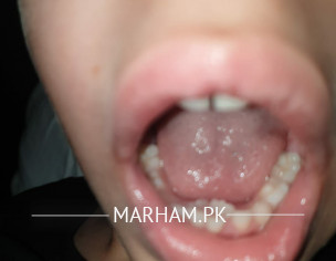 Milk Teeth Extraction