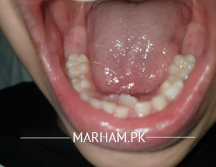 Milk Teeth Extraction
