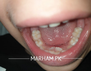 Milk Teeth Extraction