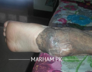 Microsurgery, Free Flap Surgery,plastic Surgery 