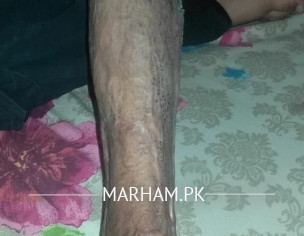 Microsurgery, Free Flap Surgery,plastic Surgery 