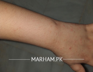 Rashes/blisters